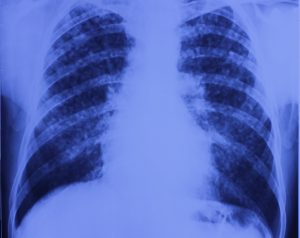 Profesionalne bolesti